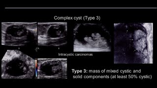 Breast Ultrasound Complicated Vs Complex Cyst [upl. by Beau287]