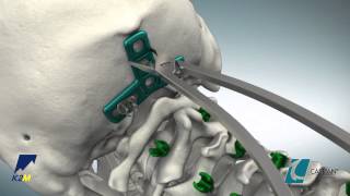 CASPIAN® Occipital Plate Product Animation [upl. by Akiras]