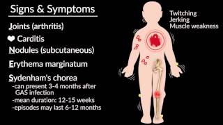 Aschoff bodies  Rheumatic Heart Disease Pathology [upl. by Tteltrab]