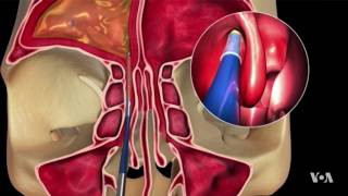 Surgically Mastering the Frontal amp Sphenoid Sinuses  Raymond Sacks MD FCS FRACS [upl. by Campney906]