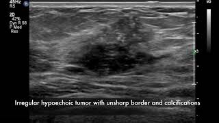 Breast ultrasound  cancer [upl. by Tonina]