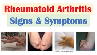 Strep Throat to Rheumatic Heart Disease [upl. by Sherard]