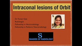 Intraconal lesions of Orbit Simplified [upl. by Atnoid]