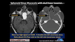 Sinusitis Causes Symptoms Diagnosis amp Allopathic Treatment In Hindi  Sinusitis Explain [upl. by Albur974]