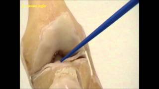 Patellar Dislocations  Everything You Need To Know  Dr Nabil Ebraheim [upl. by Sabine]