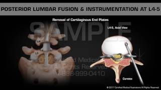 Glenohumeral Joint Injection  Ultrasound Guided [upl. by Ekeiram939]