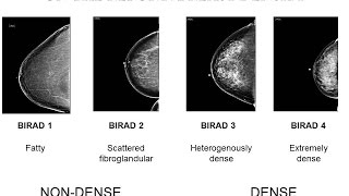 Breast Density from a Radiologists Perspective [upl. by Tyson800]