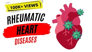 Rheumatoid Arthritis RA Signs amp Symptoms amp Associated Complications [upl. by Billy]