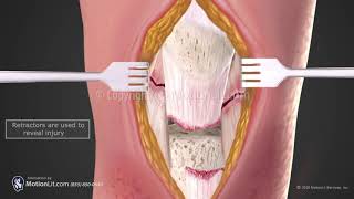 Patellofemoral Syndrome Explained [upl. by Donata]