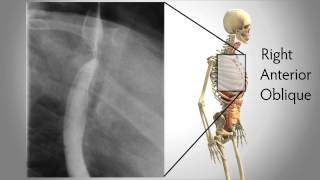 Right Anterior Oblique or RAO Position [upl. by Acinomal760]