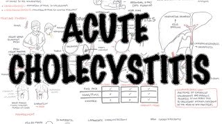 Acute Cholecystitis  Overview signs and symptoms pathophysiology treatment [upl. by Nathanil]