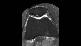 Chondromalacia patella [upl. by Lynett]