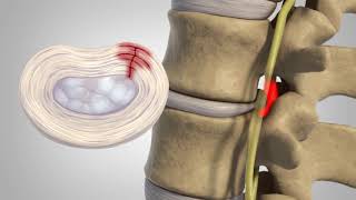 Knee Chondromalcia and Its Treatment [upl. by Mafala669]