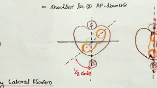 Breech Presentation Part2 Mechanism of Labour Obstetrics [upl. by Sink]