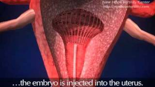 Embryo Transfer [upl. by Lorrad560]