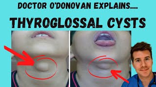 Explaining Thyroglossal Cysts  Origins Diagnosis and Management  With Dr ODonovan [upl. by Aicemak]