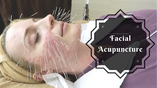 Facial Acupuncture  Korean Beauty Secret [upl. by Dera]