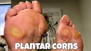 CORN REMOVAL FROM FEET  EXTREMELY SATISFYING [upl. by Semele]