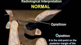 Occipitocervical Dislocation  Everything You Need To Know  Dr Nabil Ebraheim [upl. by Aropizt]