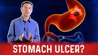 How To Get Rid Of Stomach Ulcer – DrBerg On Peptic Ulcer Treatment [upl. by Nahtnaoj]