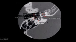 TOMOGRAFIA COMPUTADA DE OIDO PEÑASCO Y CONDUCTO AUDITIVO [upl. by Enaitsirhc]
