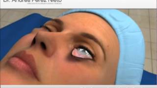 Blefaroplastia inferior [upl. by Airemahs210]